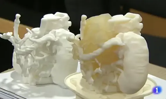Ús de la impressió 3d per extirpar tumors